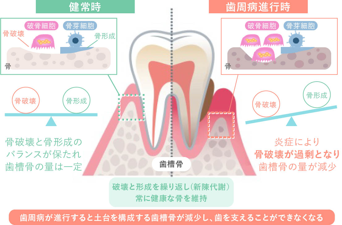 歯周病により歯槽骨が溶けるメカニズム