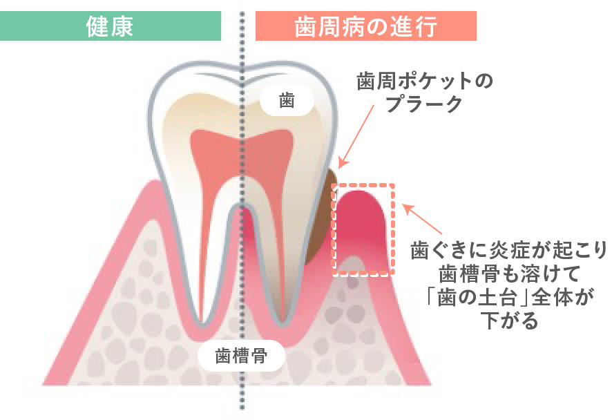歯周病は、歯と歯ぐきの間にある歯周ポケットに入り込んだ「プラーク（歯垢）」が原因で起こります