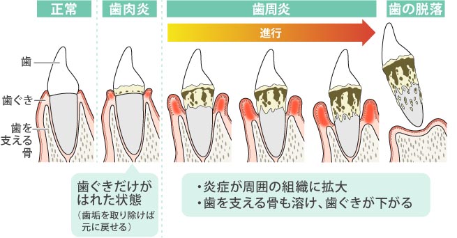 歯周病　進行　炎症が周囲の組織に拡大　歯をさせる骨も溶け、歯ぐきが下がる