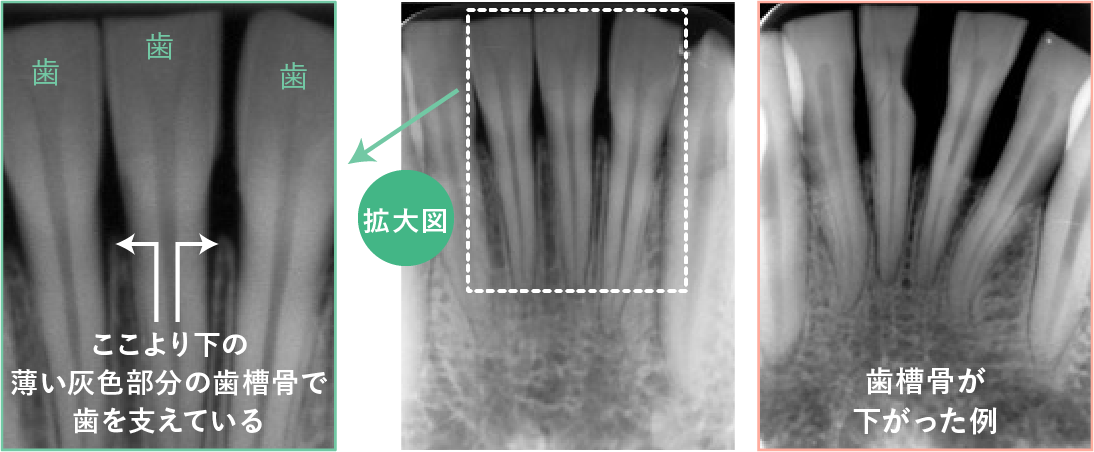 X線撮影によると歯と歯槽骨の像