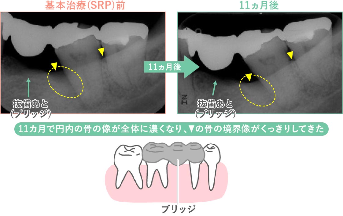 基本治療で歯槽骨が回復した症例（X線写真での比較）