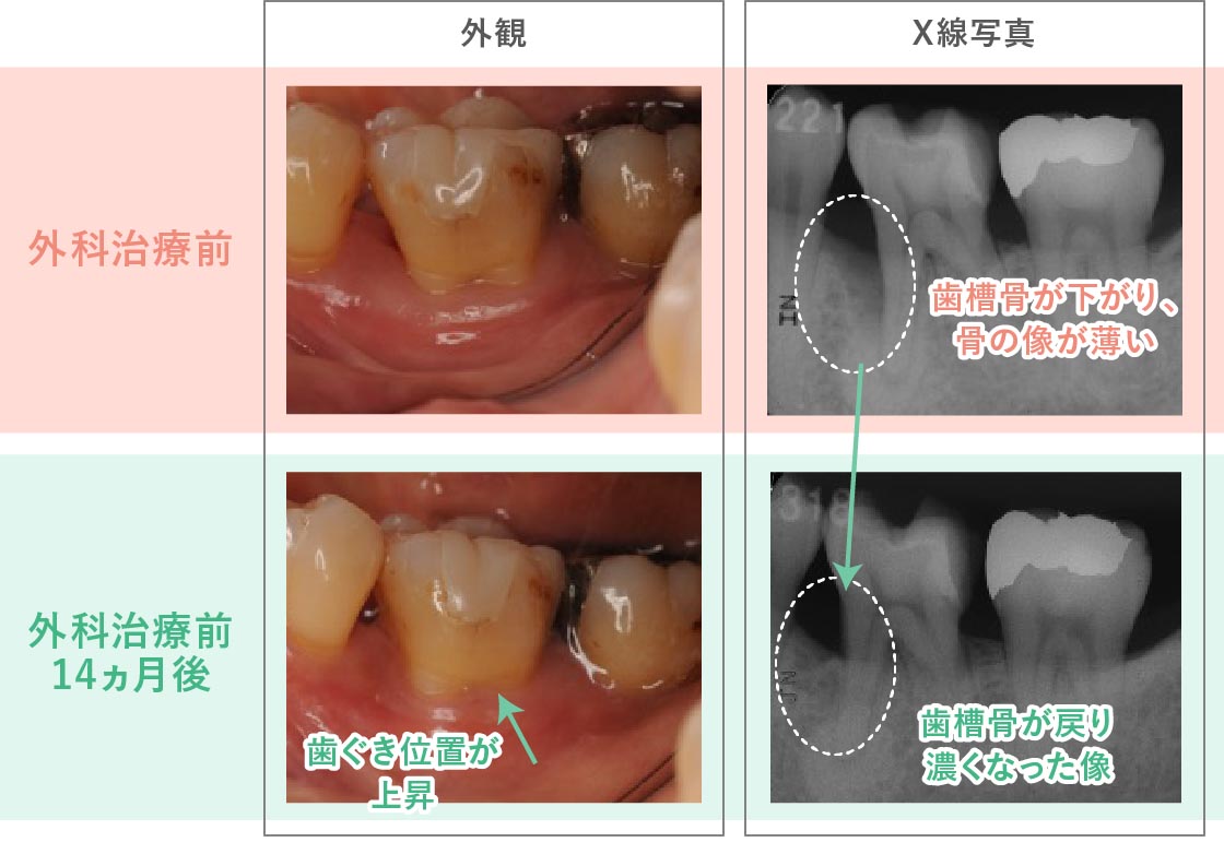 歯周外科治療により歯槽骨が回復した症例