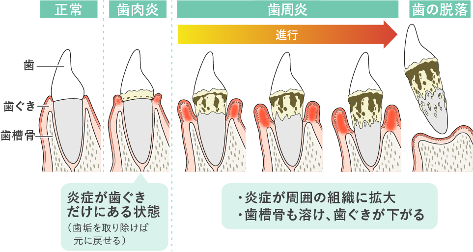 歯周病とは　症状が進行すると歯槽骨が溶けて、最後には歯が抜け落ちることもあります