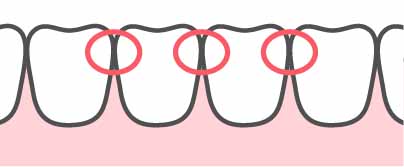 問１　「タフトブラシ」とは、歯と歯が接した部分（図中の円内）の清掃に適したハブラシのことである。