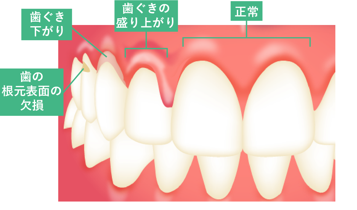 オーバーブラッシングによる歯や歯ぐきの異常