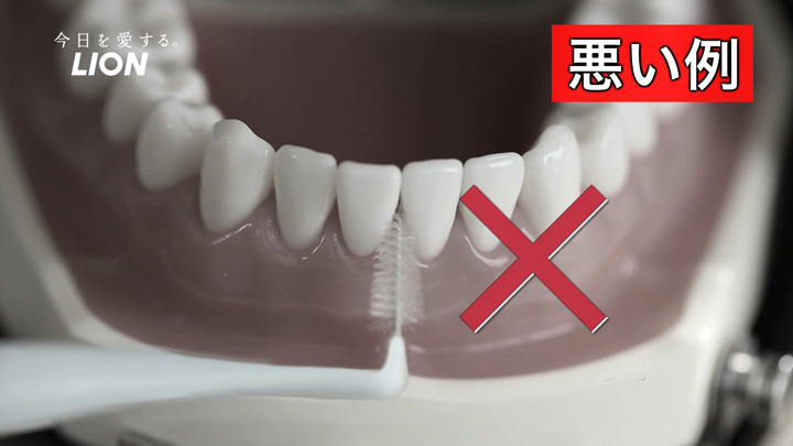 狭い隙間に大きすぎる歯間ブラシを使うと、歯肉退縮の原因に