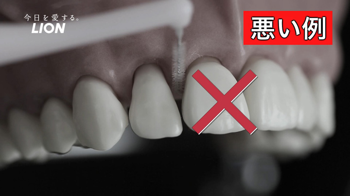  広い隙間に小さすぎる歯間ブラシを使うと、歯垢を十分に落とせない