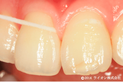 歯と歯茎の境目の溝の中にも歯垢が入りこんでいます。力を入れすぎずにデンタルフロスがスッと入る所まで、注意しながら清掃しましょう。