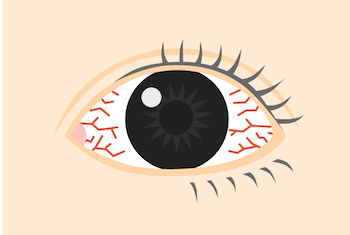 充血 病気 の 目 朝起きたら目が真っ赤…「白目の出血」は眼科に行くべき？