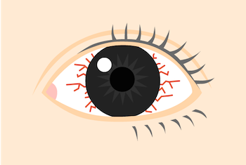 目 の 充血 片目