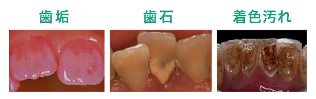 歯の汚れの種類とは？歯垢や歯石、着色汚れなど種類に合わせた落とし方 | Lidea(リディア) by LION
