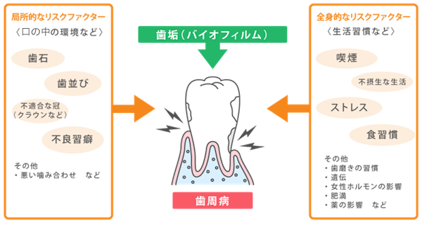 歯周病を引き起こす間接的な「リスクファクター」